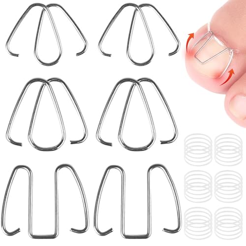 ISOYTERO 6pcs Correcteur d'ongles incarné, correcteurs d'ongles à Orteils incarnés
